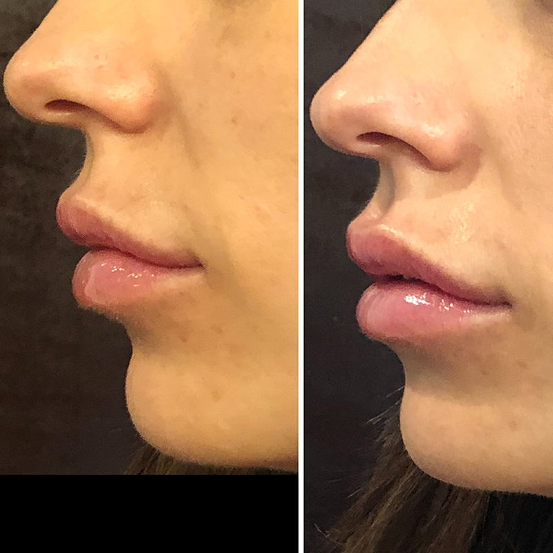 Lip Filler (Restylane Lyft)