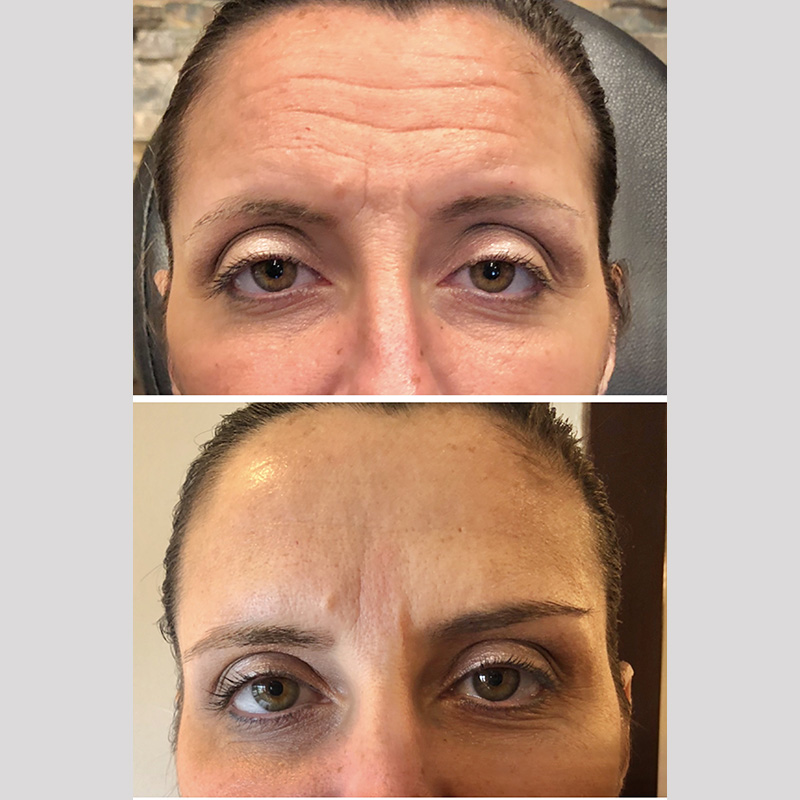Dysport Forehead & Glabella