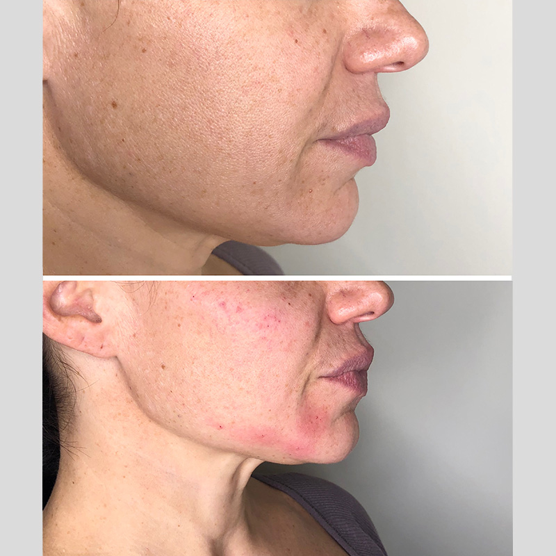Jaw Lift Filler 2.25ml Radiesse