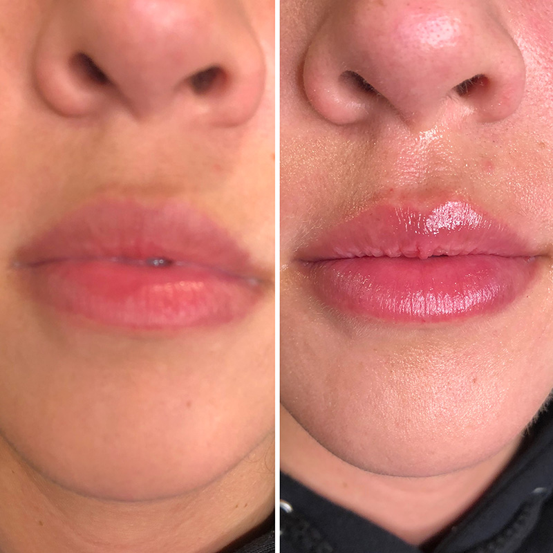 Lips with Cupid’s Bow Filler