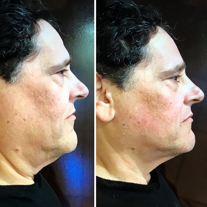 Ultherapy® 90 Days Post Treatment