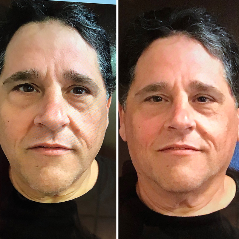 Ultherapy® 90 Days Post Treatment