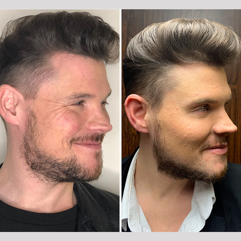 Xeomin For Crows Feet