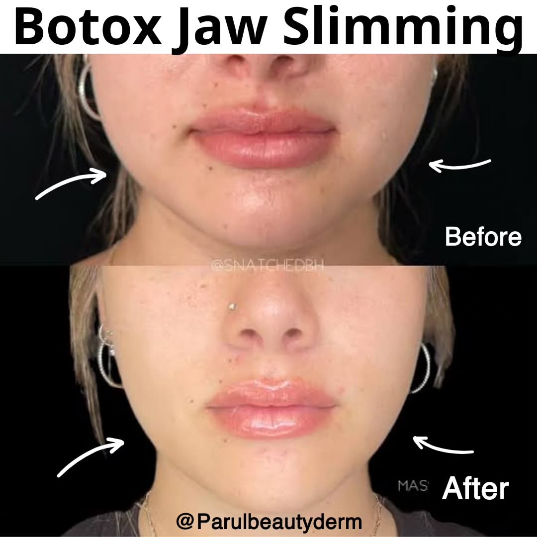 Botox Jaw Slimming Before & After