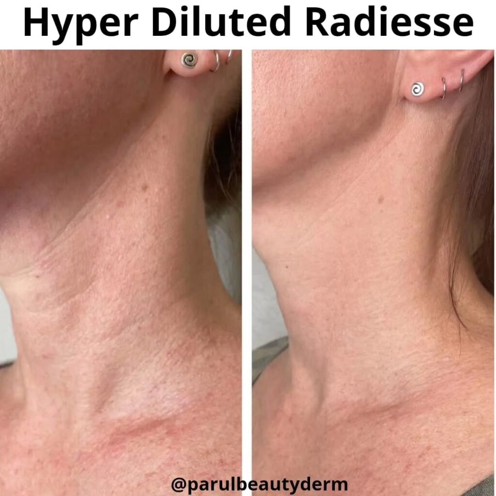 Radiesse Treatment Before & After