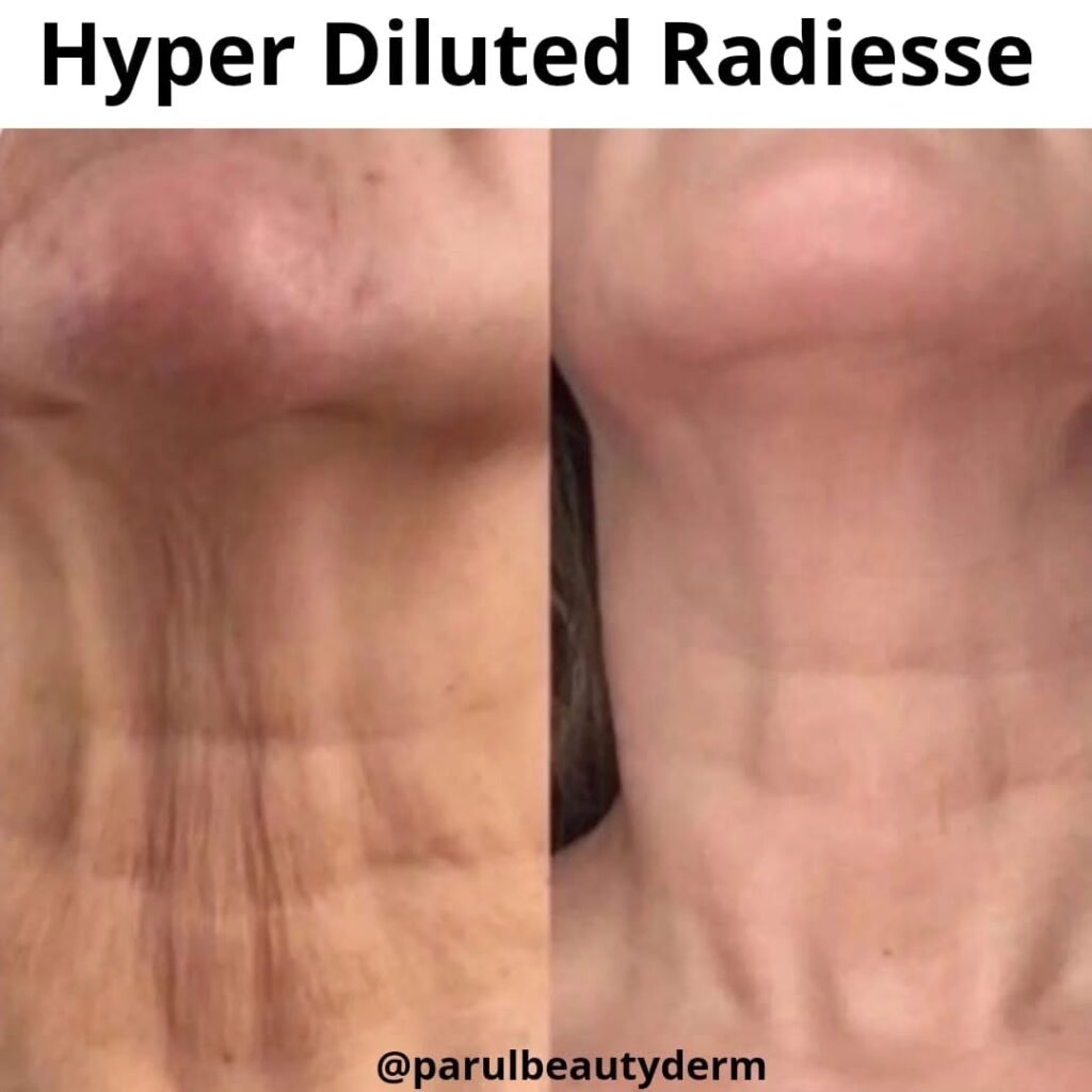 Radiesse Treatment Before & After