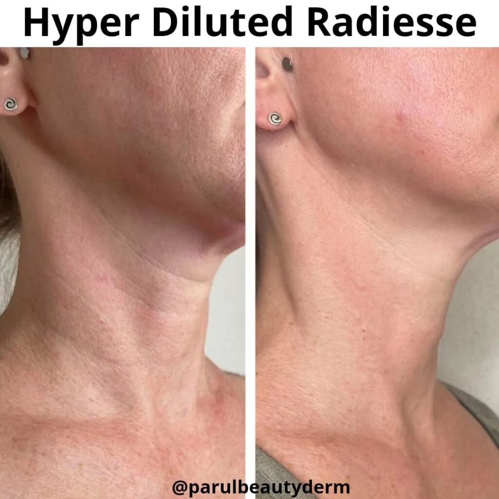 Radiesse Treatment Before & After