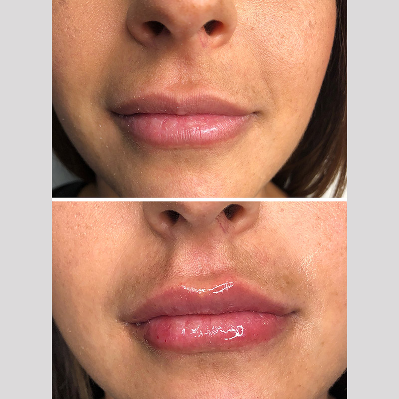 Lips & Cupid Bow / 1ML Versa