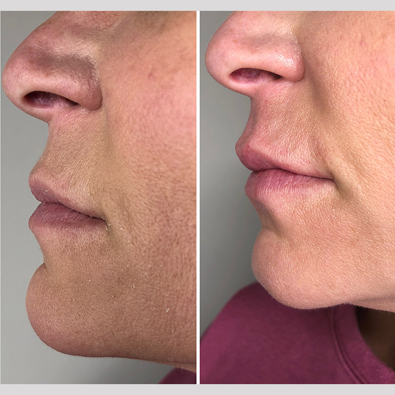 Lips & Cupid Bow Filler