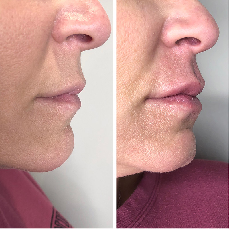 Lips & Cupid Bow Filler