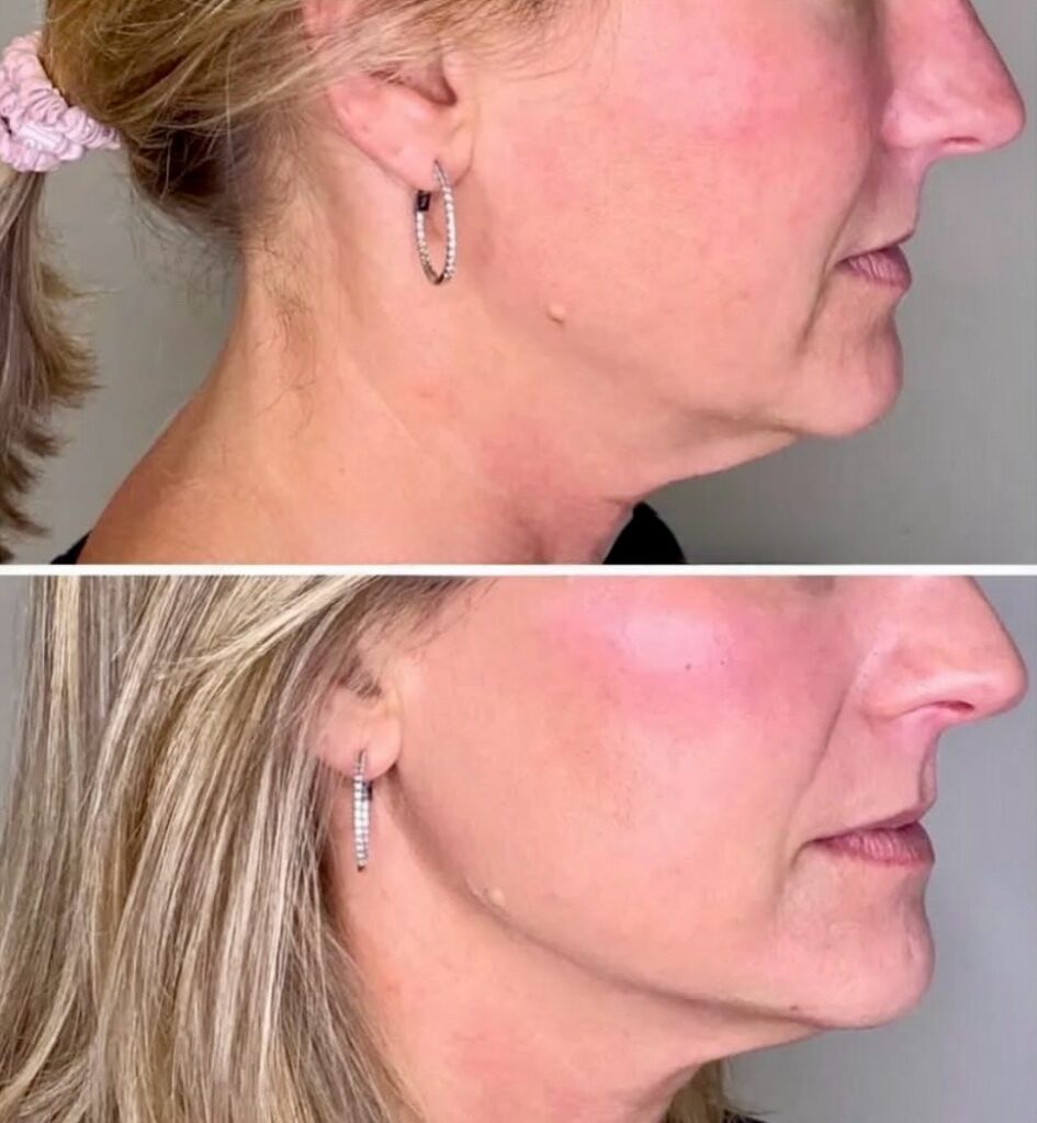 Liquid Facelift