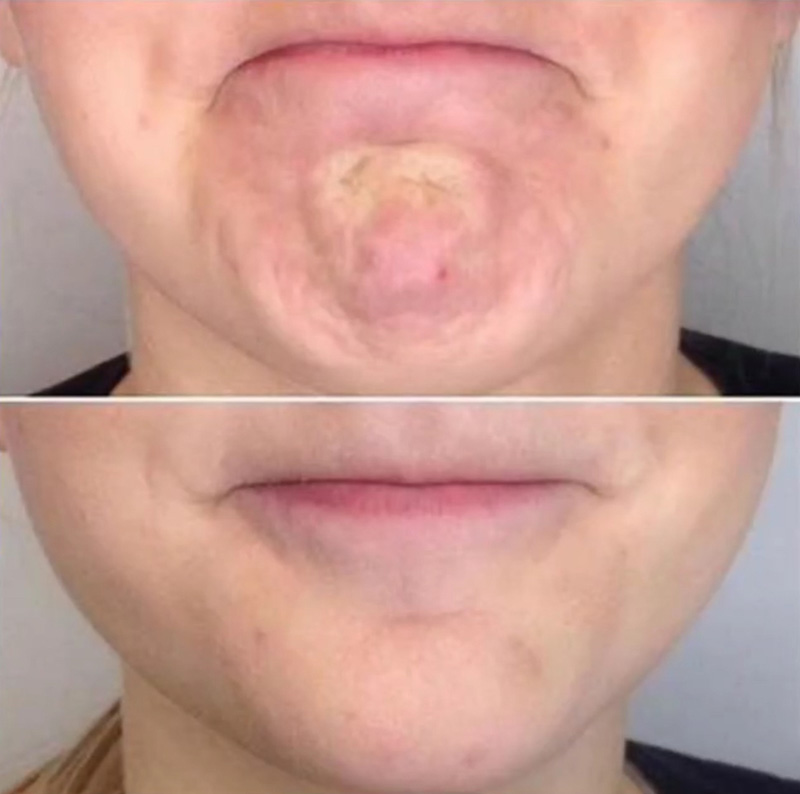 Botox Before & After