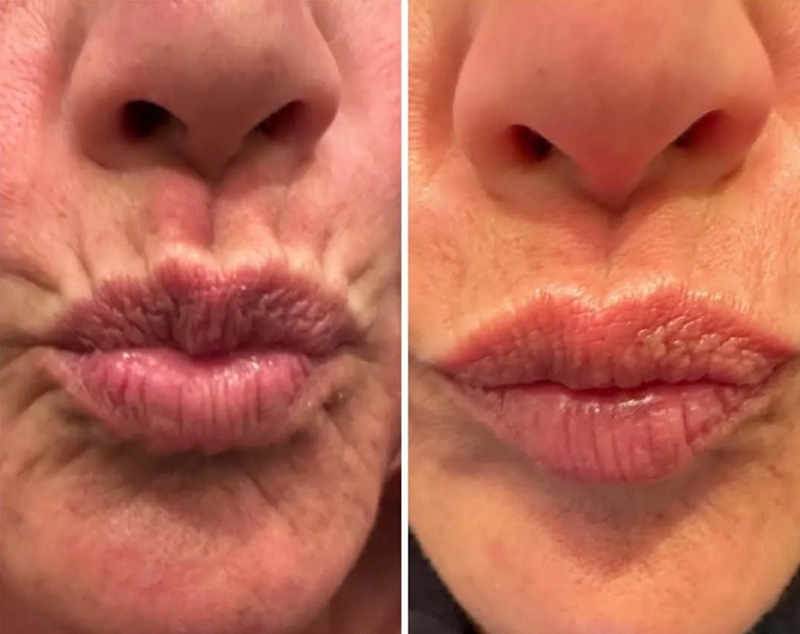 Dysport Before & After