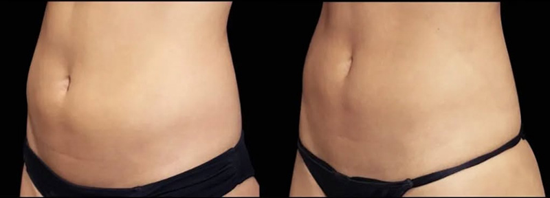 Evolve X Before and After