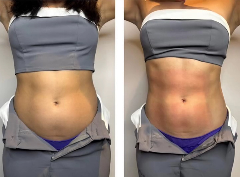 Evolve X Before & After Results