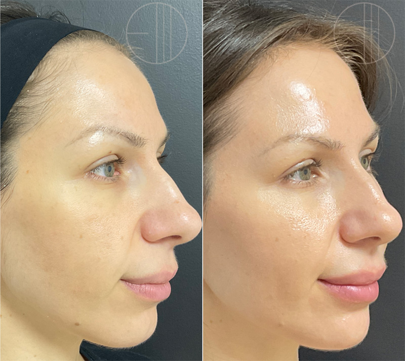 LaseMD Before and After