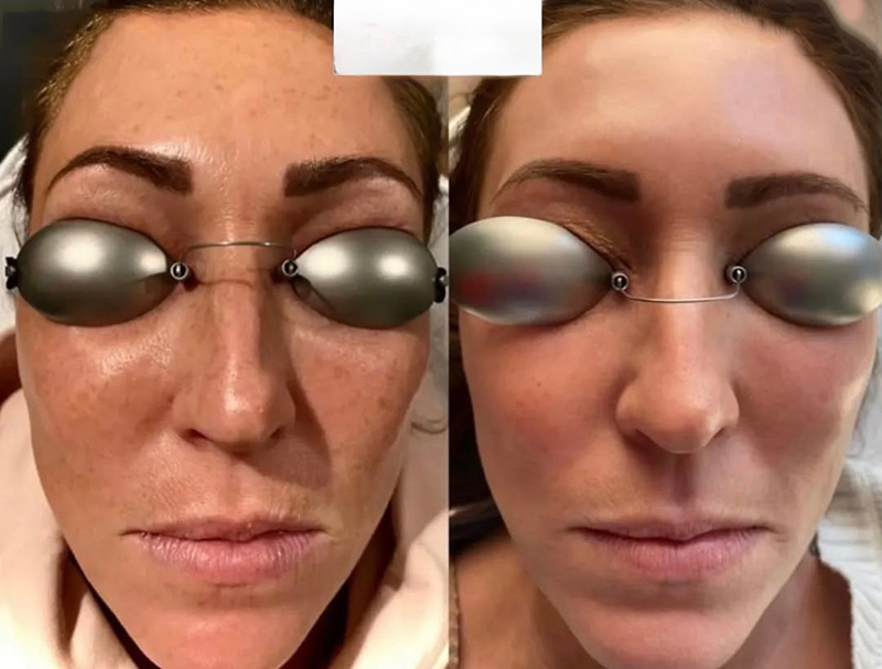 LaseMD Before and After