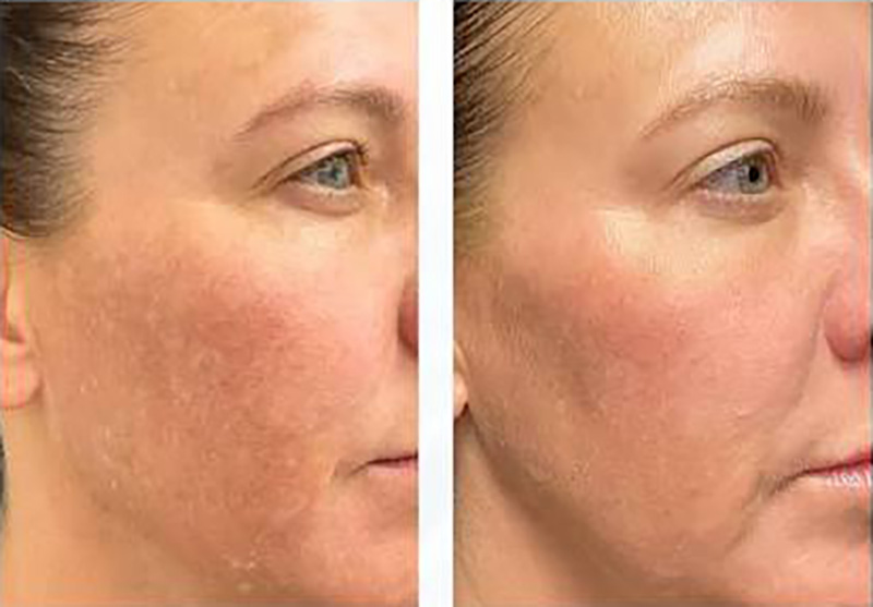 LaseMD Before and After