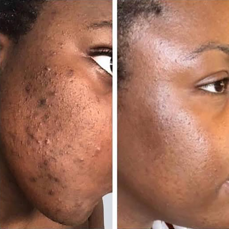 LaseMD Before and After