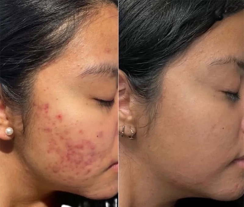 LaseMD Before & After Results