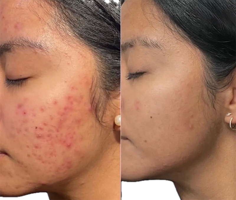 LaseMD Before & After Results