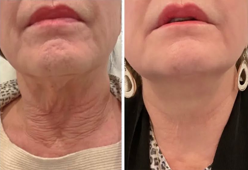 Morpheus Before & After 4 Weeks