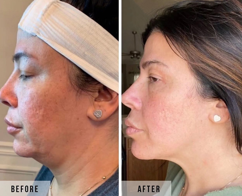 Morpheus Before & After