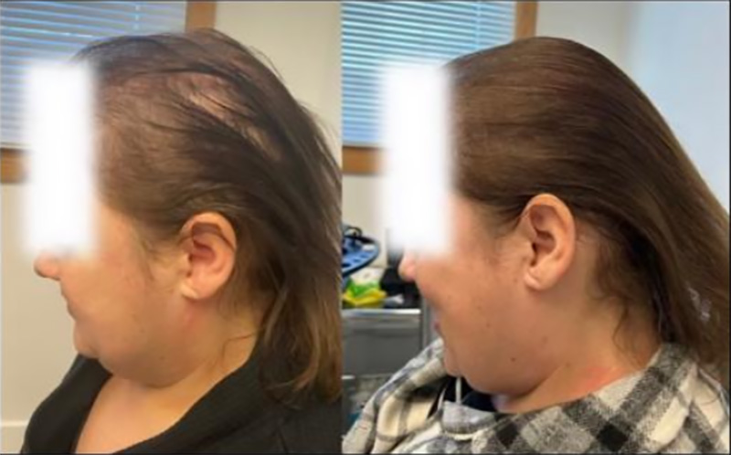 Post 3X TED® Treatments After Full Cranial Radiation / Courtesy of Hair Restoration Experts