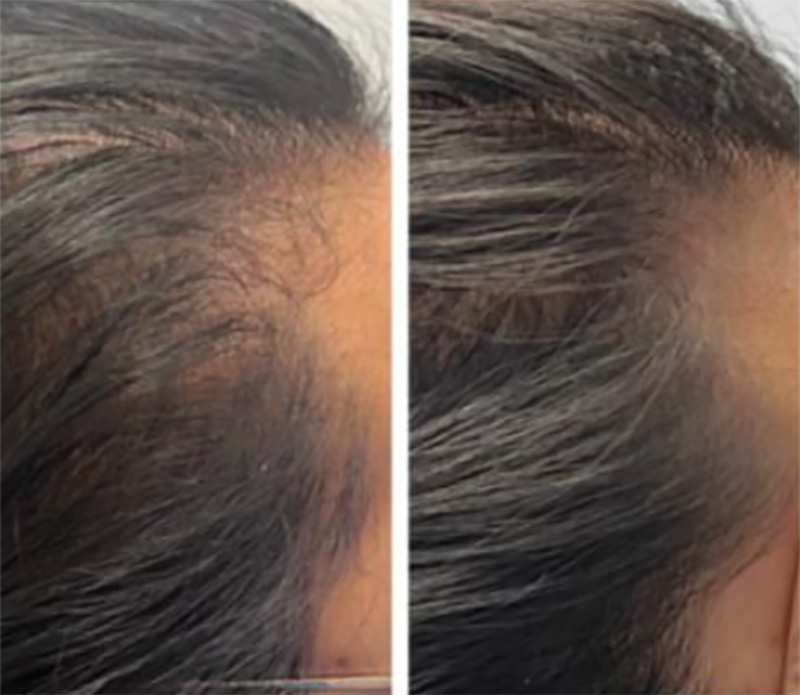 Post 3X TED® Treatments addressing Digestive Issues & Malabsorption / Courtesy of Hair Restoration Experts