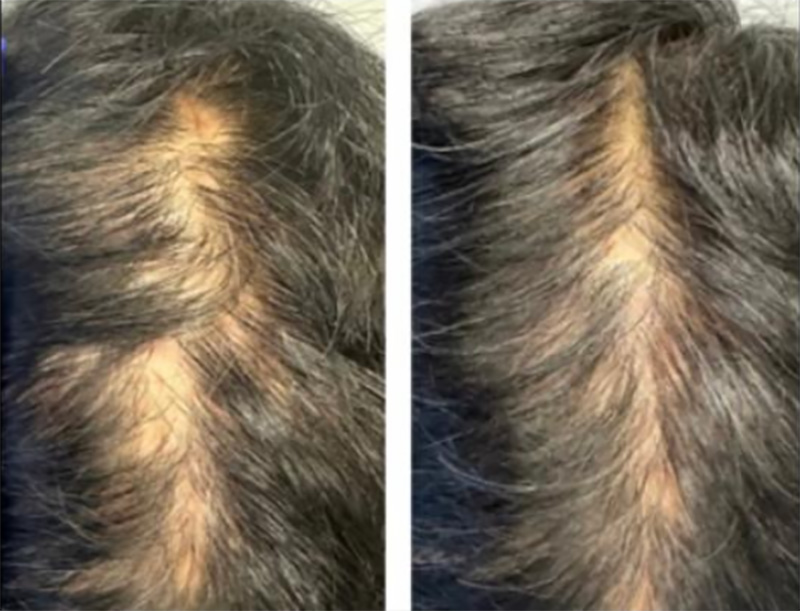 Post 3X TED® Treatments addressing Lichen Planopilaris &Pseudo Pilade of Brocq / Courtesy of Hair Restoration Experts