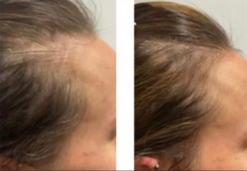 Post 3X TED® Results After 3 Treatments Treatments addressing Lupus & Graves Disease / Courtesy of Hair Restoration Experts