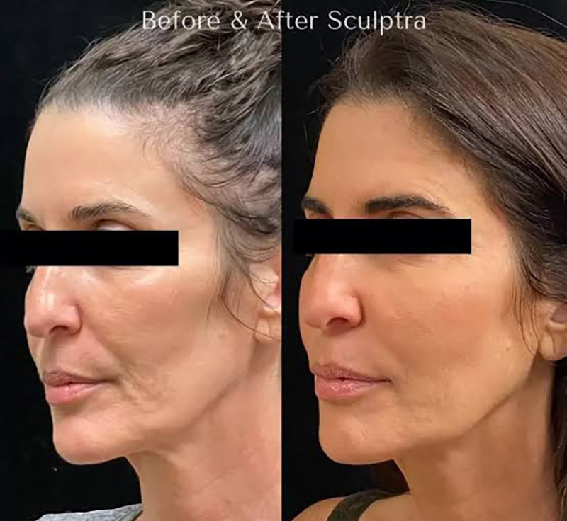 Sculptra Before and After Courtesy Tricia Brown, MD