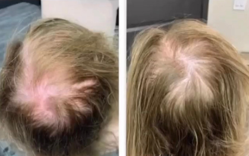 TED® Treatment 4 Weeks Post 1 Treatment Courtesy of Majestic