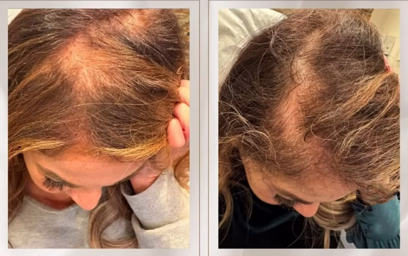 TED® Hair Treatment Post 1 Session