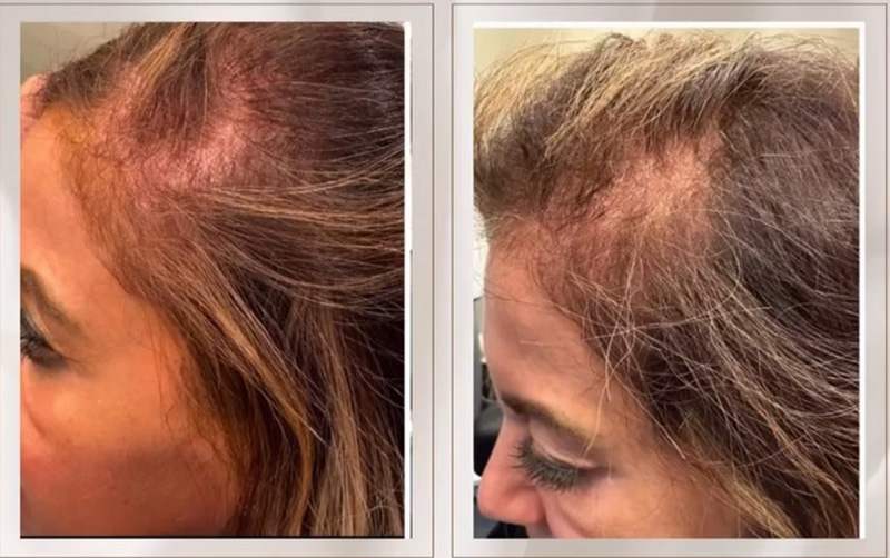 TED® Treatment Post 1 Treatment