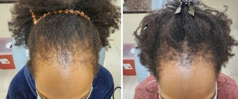 TED® Hair Treatment Post Session