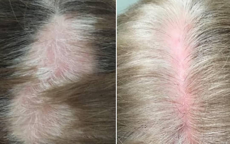 TED® Hair Treatment Results