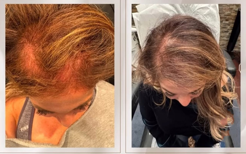 TED® Hair Treatment Post 1 Treatment