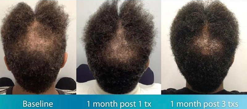 TED® Hair Treatment Courtesy of Lady Dy, MD, FAAD