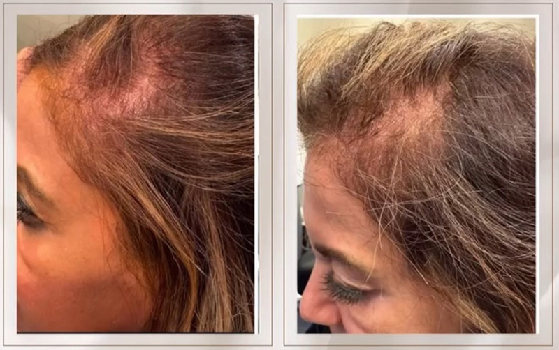 TED® Hair Treatment Post 1 Session