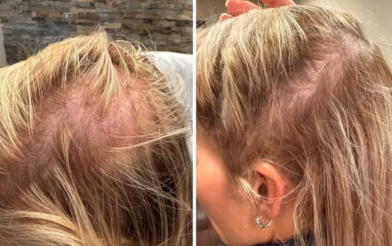 TED® Hair Treatment Post 1 Treatment