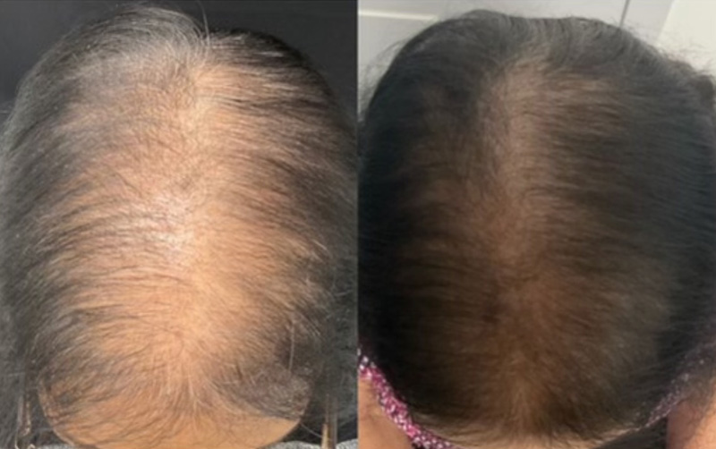 TED® Treatment Post 4 Sessions Courtesy Alma via Sapana Patel DNP-BC