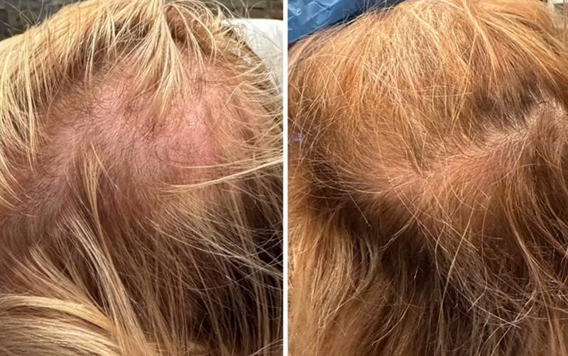 TED® Hair Treatment Post 1 Session