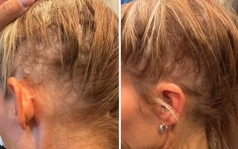 TED® Treatment Post 1 Session