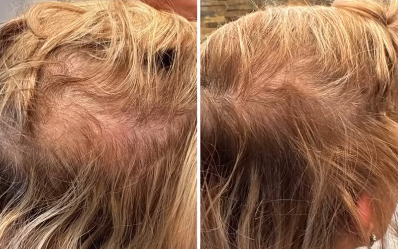 TED® Hair Treatment Post 1 Session