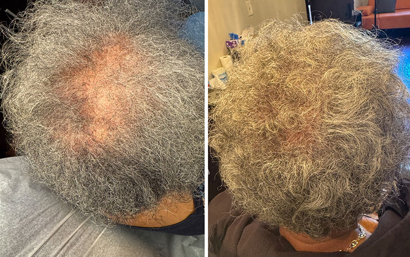 TED® Post Treatments