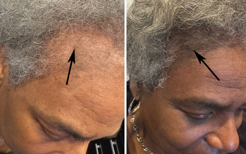 TED® Post Treatments