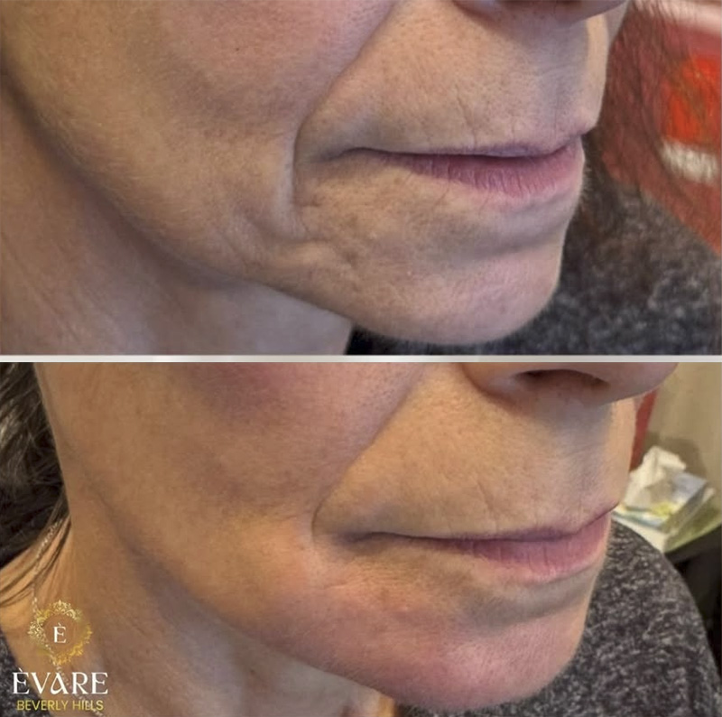 Cheek & Jaw Lift Achieved W/ Hyperdiluted Radiesse