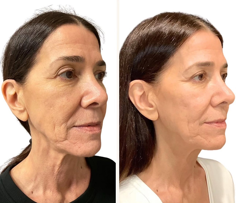 Morpheus Before & After