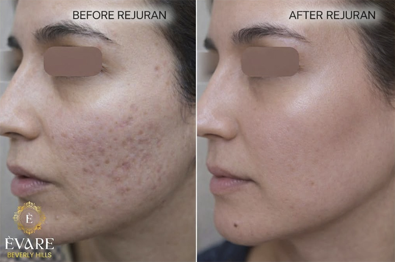 Rejuran Before & After Treatment